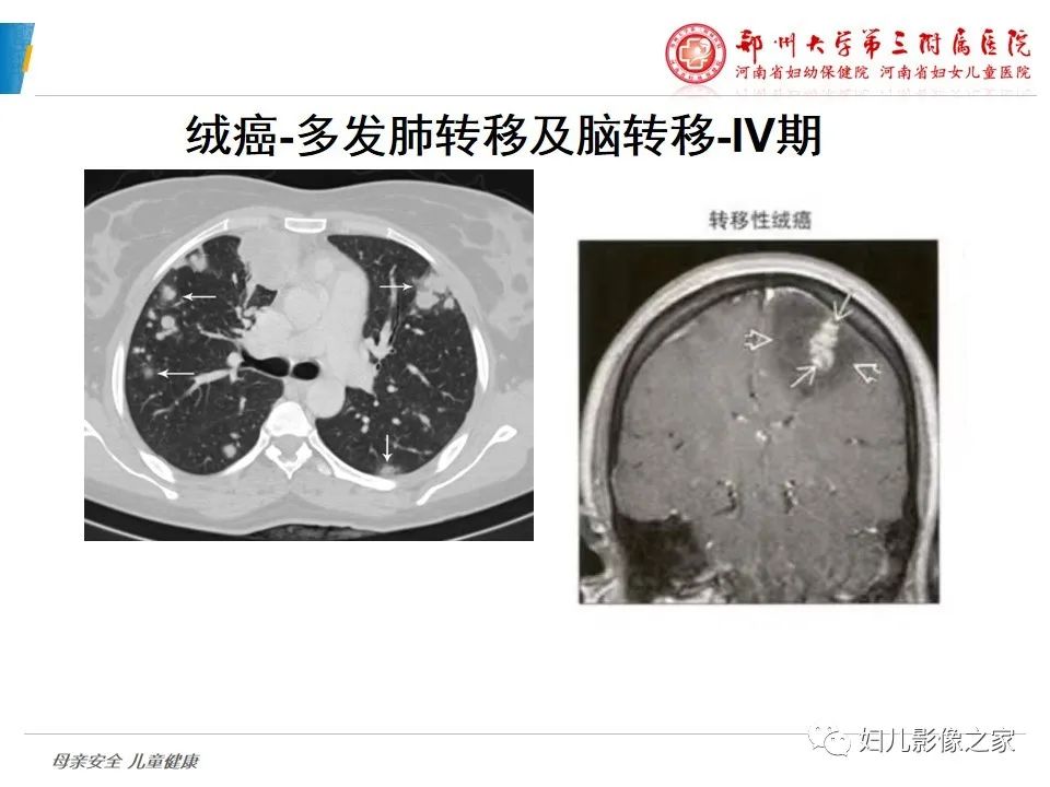影像PPT - 【PPT】滋养细胞疾病CT/MR诊断-30