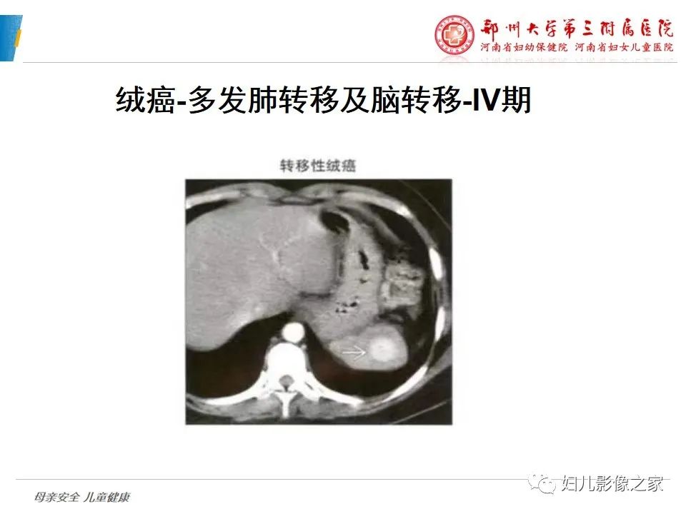 影像PPT - 【PPT】滋养细胞疾病CT/MR诊断-31