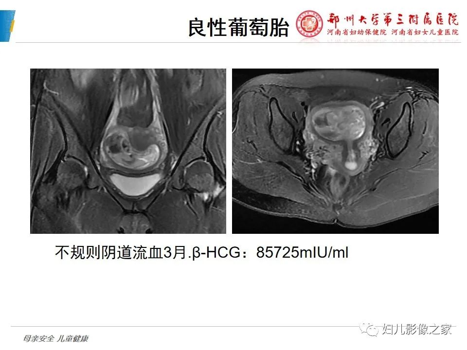 影像PPT - 【PPT】滋养细胞疾病CT/MR诊断-33