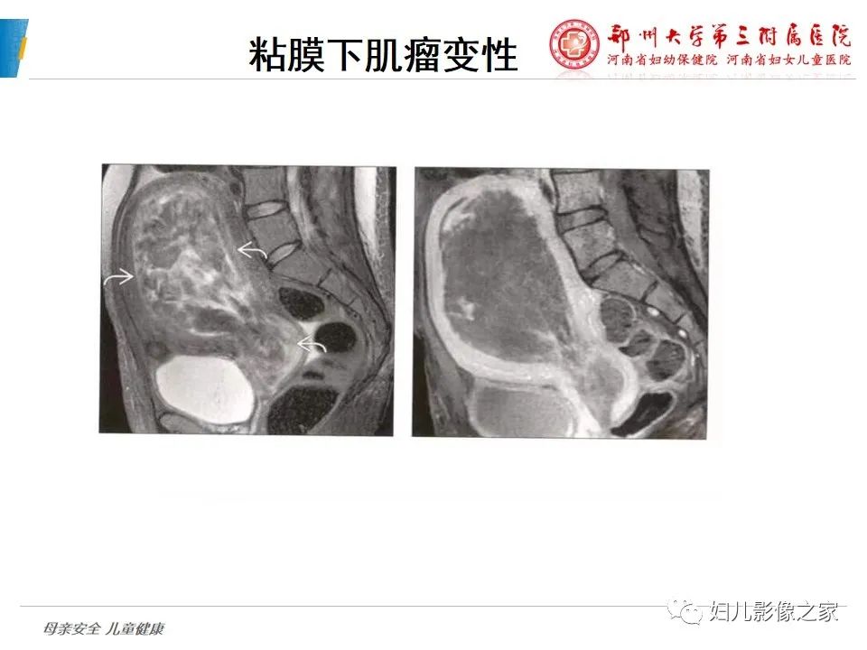 影像PPT - 【PPT】滋养细胞疾病CT/MR诊断-36