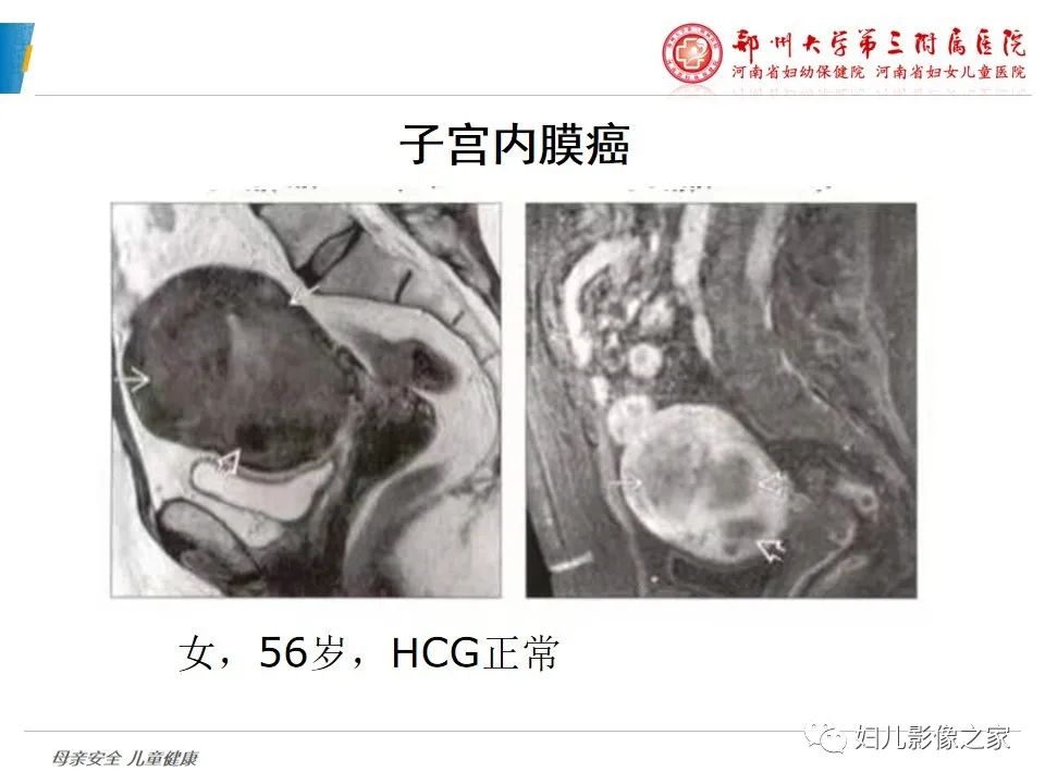 影像PPT - 【PPT】滋养细胞疾病CT/MR诊断-38