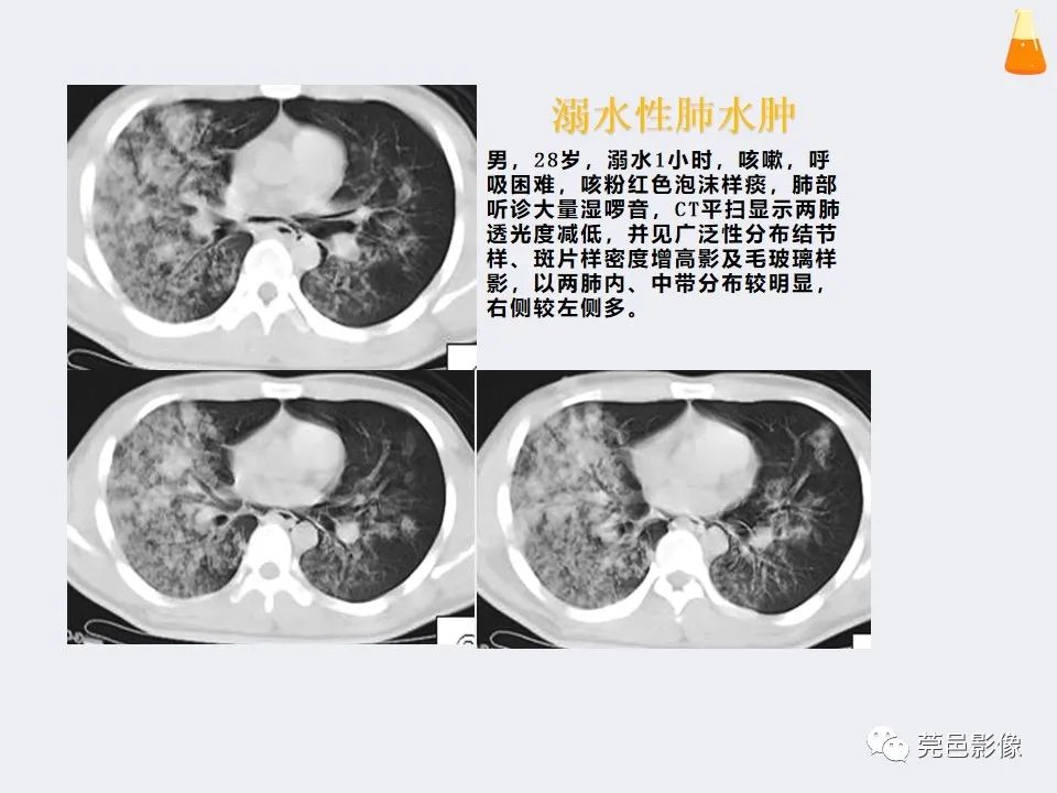 影像PPT - 【PPT】溺水性肺水肿-23