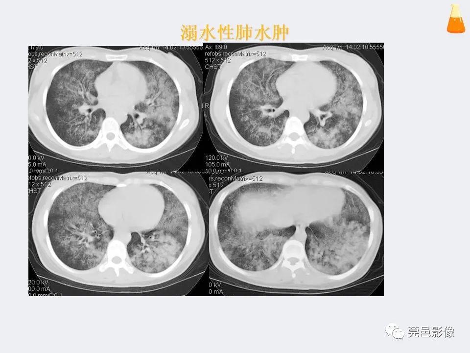影像PPT - 【PPT】溺水性肺水肿-25