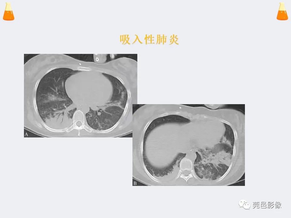 影像PPT - 【PPT】溺水性肺水肿-29