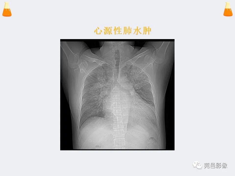 影像PPT - 【PPT】溺水性肺水肿-35