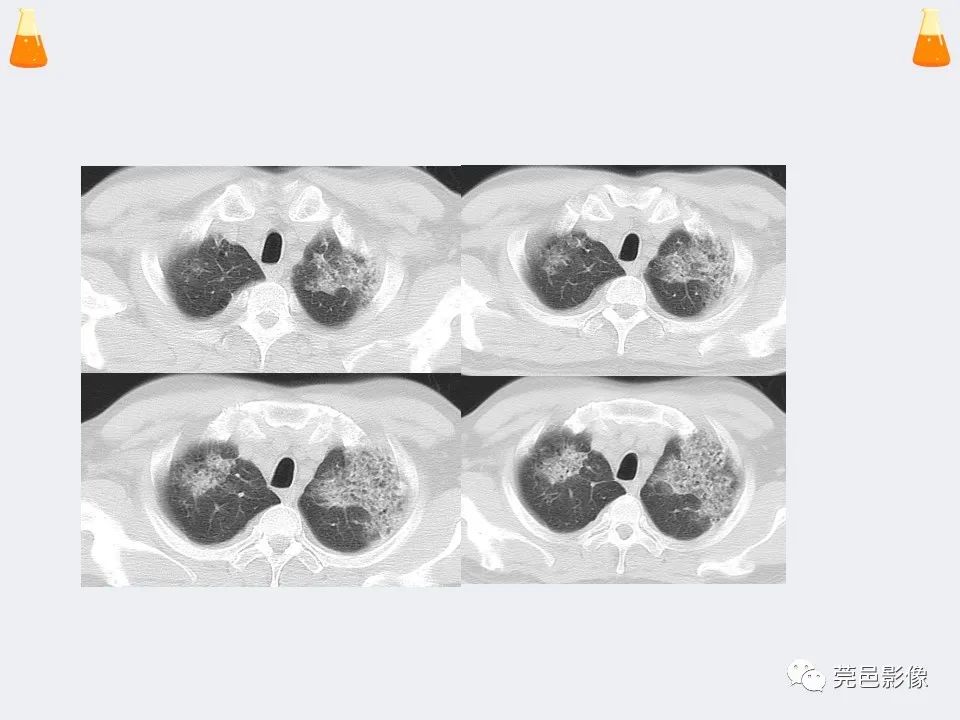 影像PPT - 【PPT】溺水性肺水肿-36