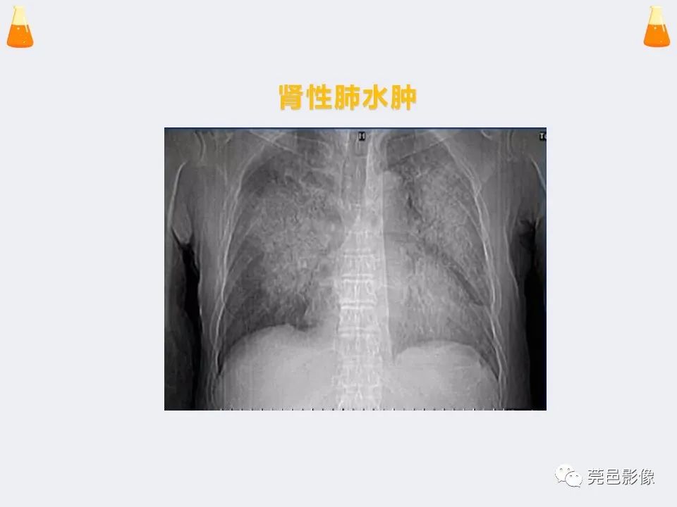影像PPT - 【PPT】溺水性肺水肿-43