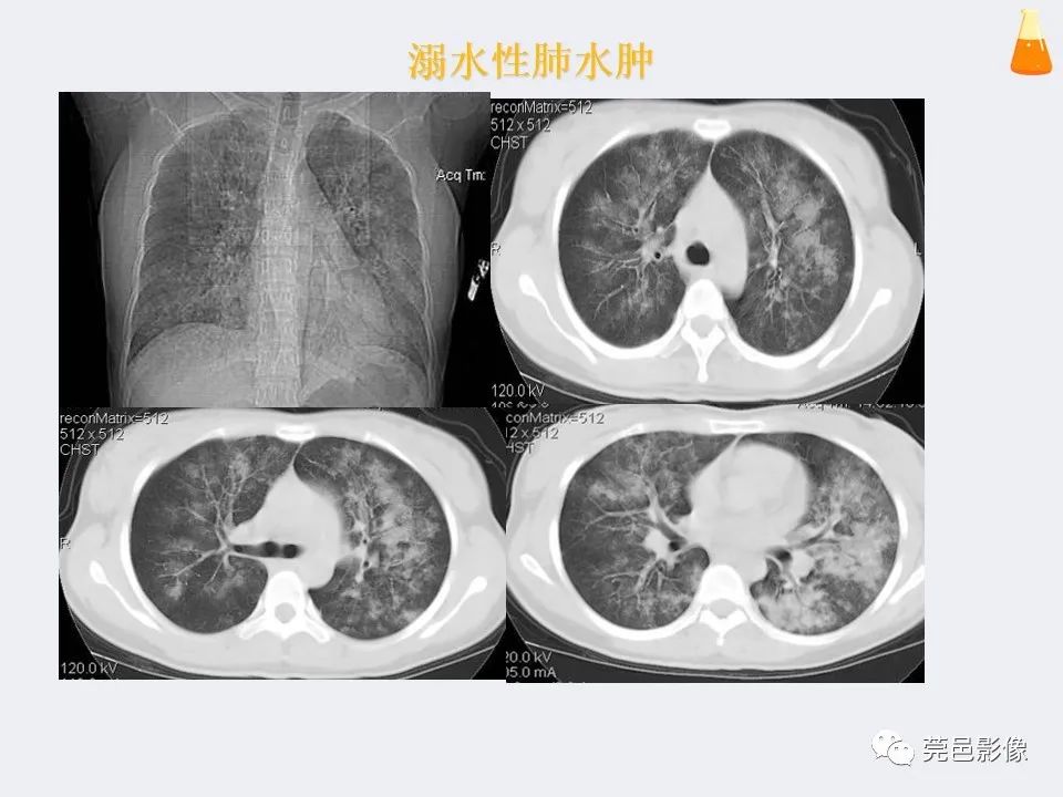 影像PPT - 【PPT】溺水性肺水肿-16