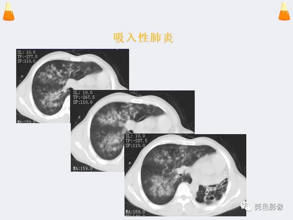 影像PPT - 【PPT】溺水性肺水肿-19