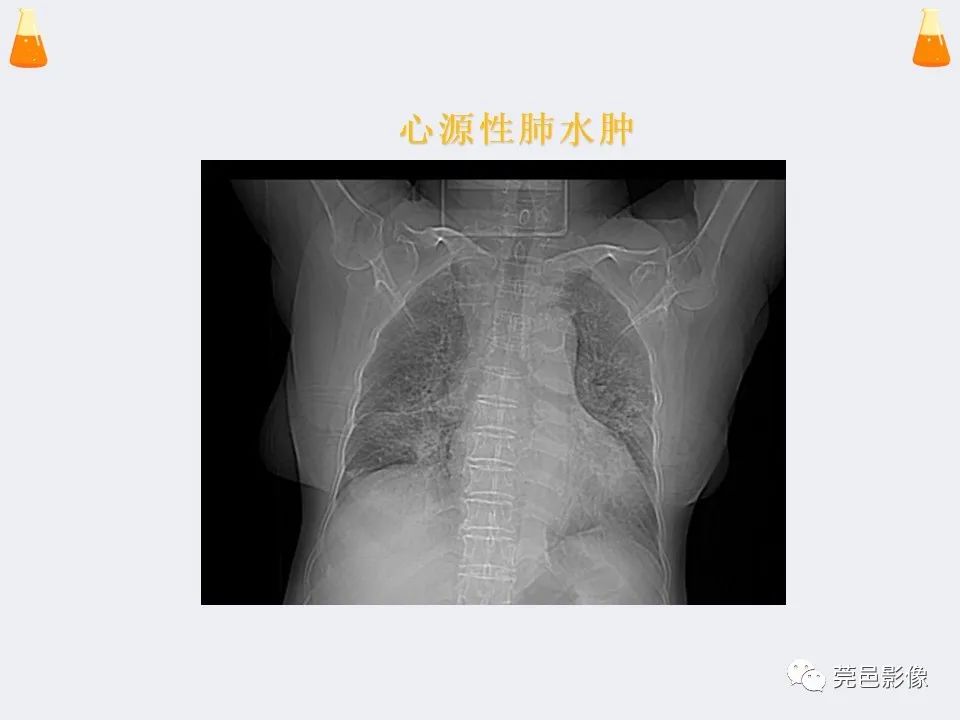 影像PPT - 【PPT】溺水性肺水肿-20