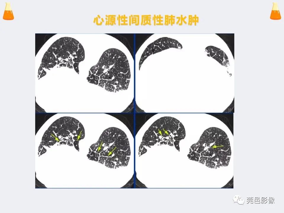影像PPT - 【PPT】溺水性肺水肿-26