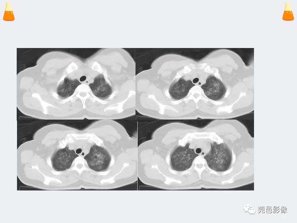 影像PPT - 【PPT】溺水性肺水肿-3