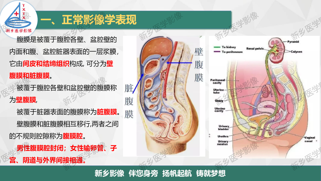 影像PPT - 【PPT】腹膜解剖及腹膜病变影像表现-3