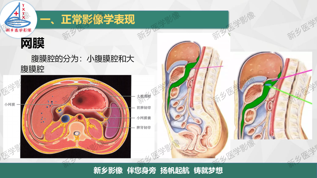 影像PPT - 【PPT】腹膜解剖及腹膜病变影像表现-5