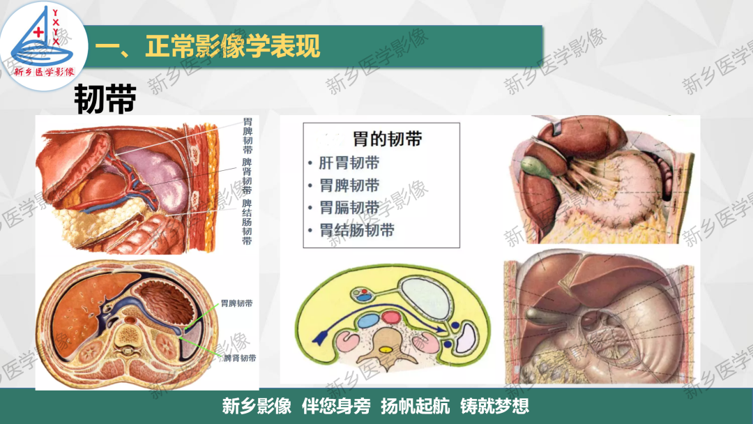 影像PPT - 【PPT】腹膜解剖及腹膜病变影像表现-8