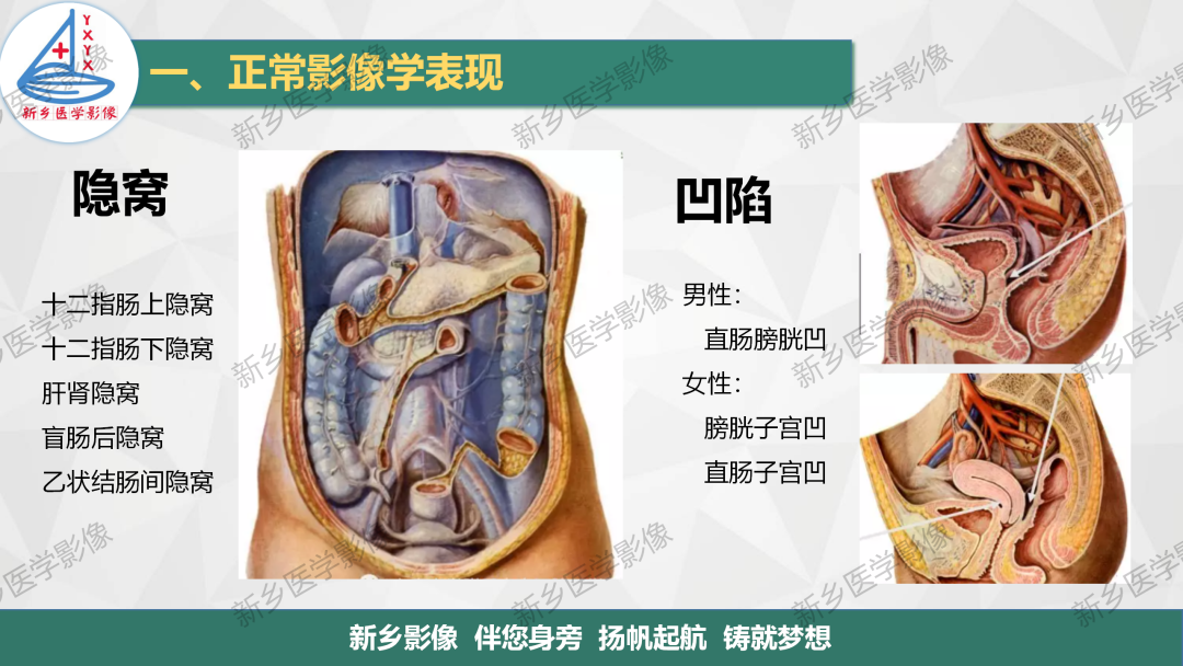影像PPT - 【PPT】腹膜解剖及腹膜病变影像表现-9