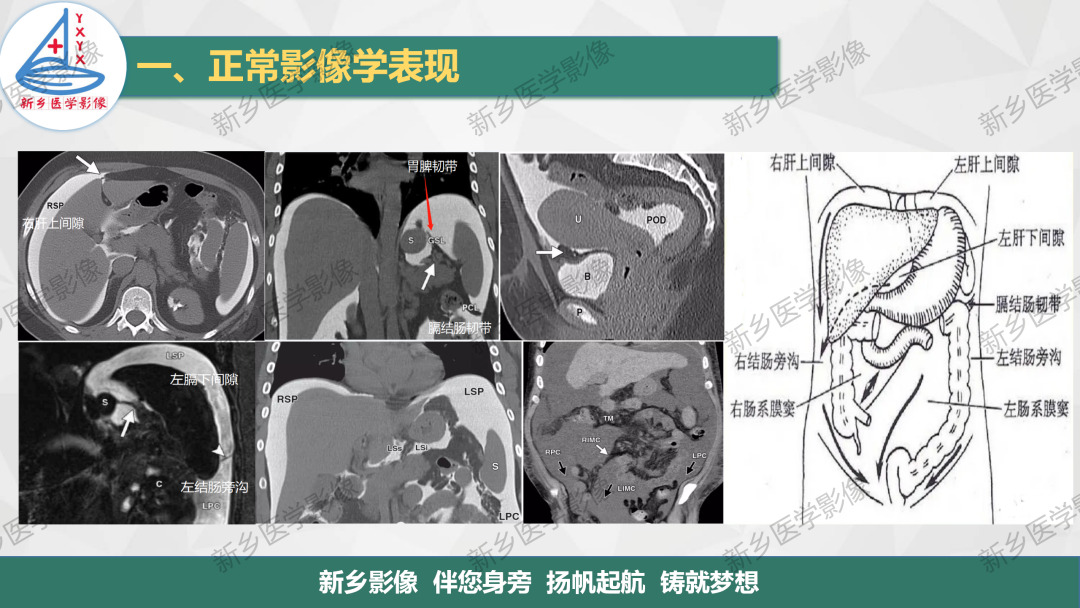 影像PPT - 【PPT】腹膜解剖及腹膜病变影像表现-12