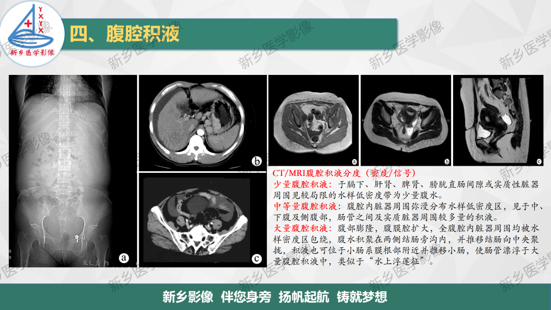 影像PPT - 【PPT】腹膜解剖及腹膜病变影像表现-16