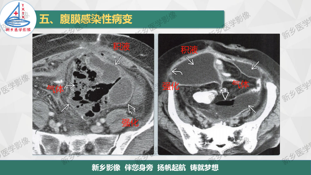 影像PPT - 【PPT】腹膜解剖及腹膜病变影像表现-22
