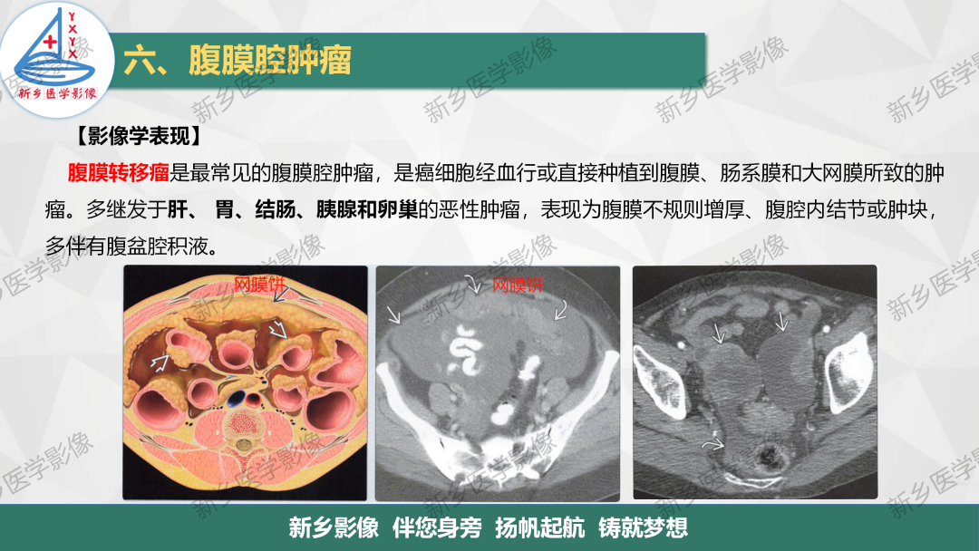影像PPT - 【PPT】腹膜解剖及腹膜病变影像表现-24