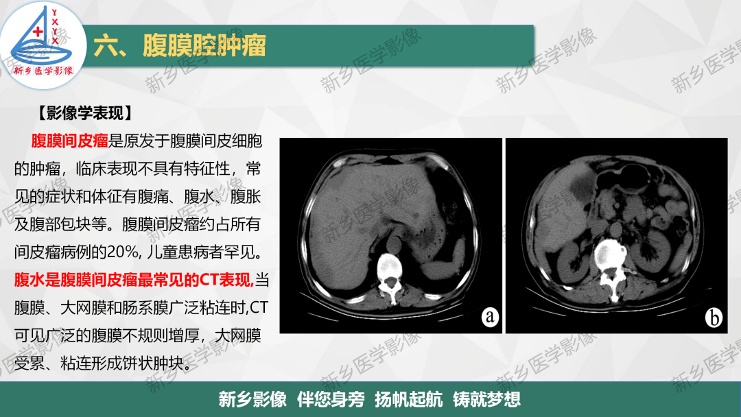 影像PPT - 【PPT】腹膜解剖及腹膜病变影像表现-25