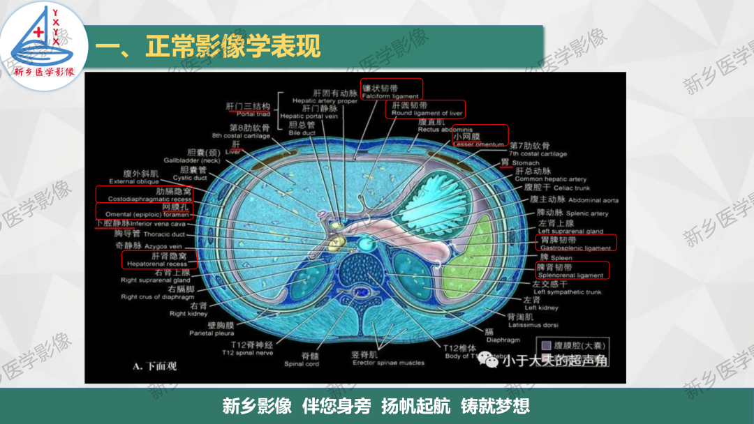影像PPT - 【PPT】腹膜解剖及腹膜病变影像表现-4