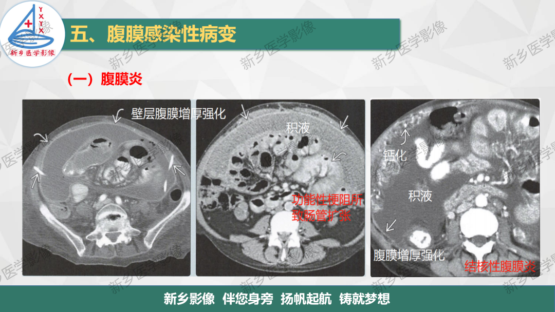 影像PPT - 【PPT】腹膜解剖及腹膜病变影像表现-8
