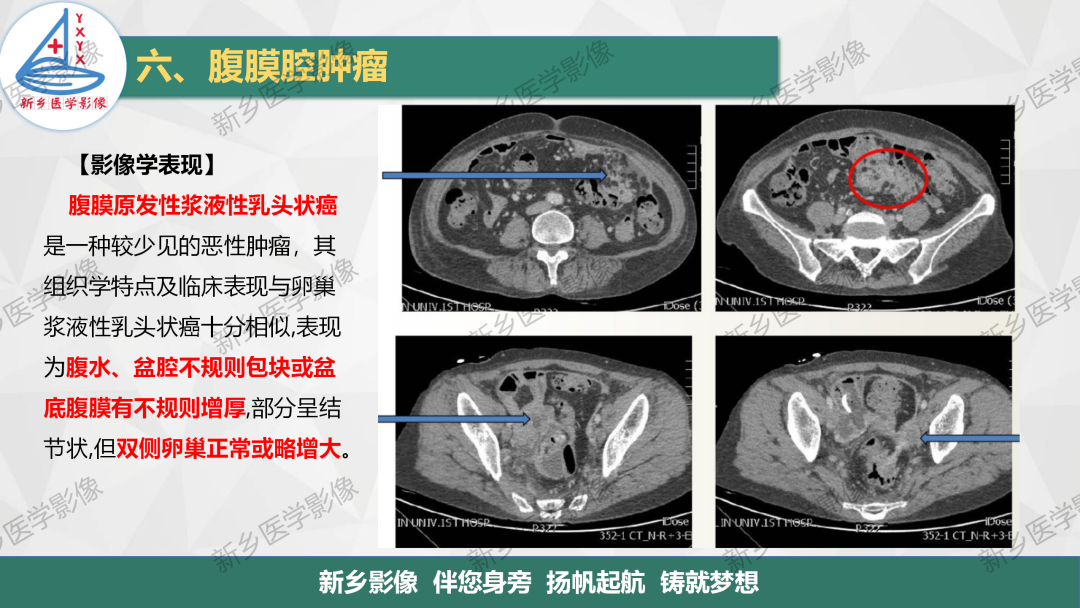 影像PPT - 【PPT】腹膜解剖及腹膜病变影像表现-4