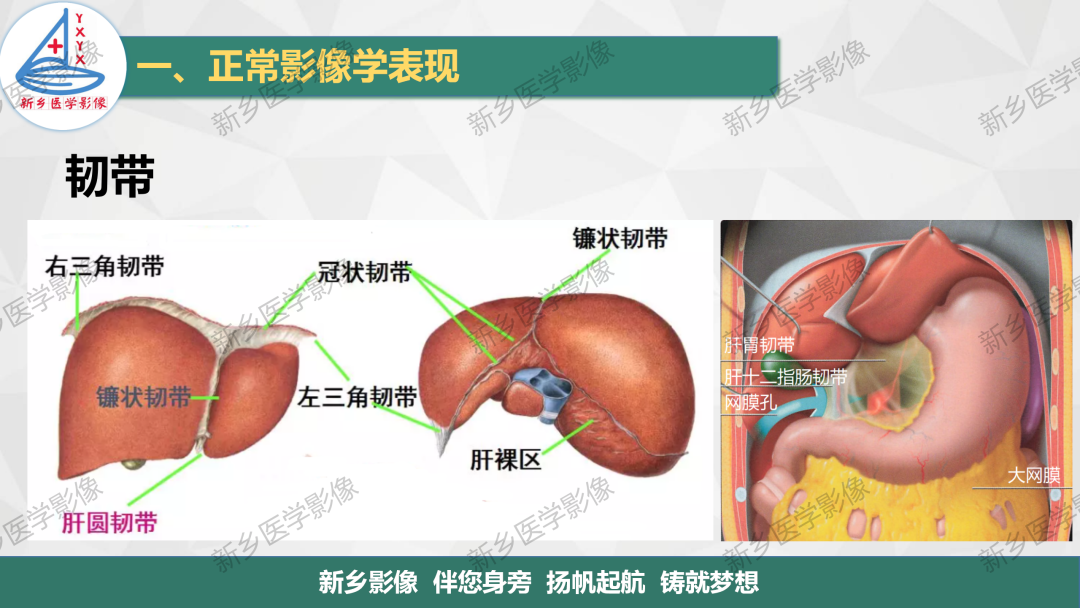 影像PPT - 【PPT】腹膜解剖及腹膜病变影像表现-2