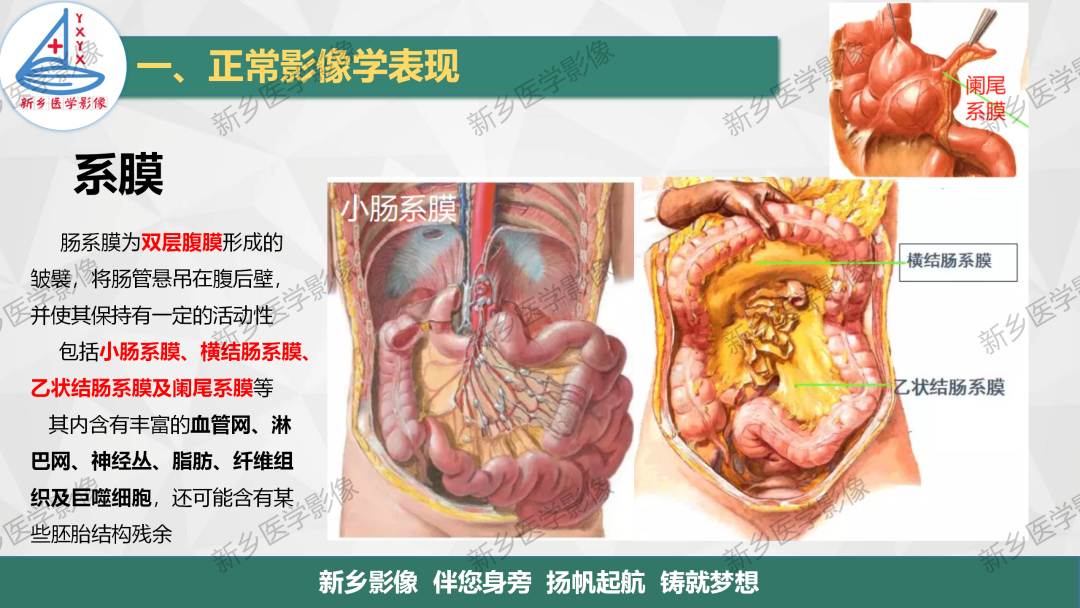影像PPT - 【PPT】腹膜解剖及腹膜病变影像表现-1