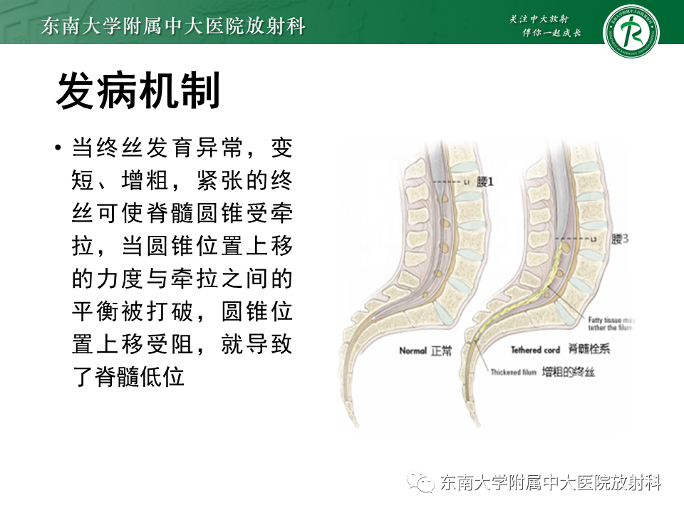 影像PPT - 【PPT】原发性脊髓拴系综合征-10 影像PPT - 【PPT】原发性脊髓拴系综合征-10