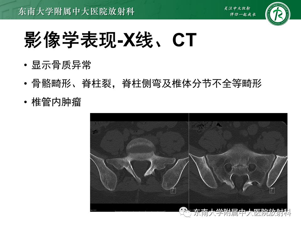 影像PPT - 【PPT】原发性脊髓拴系综合征-14 影像PPT - 【PPT】原发性脊髓拴系综合征-14