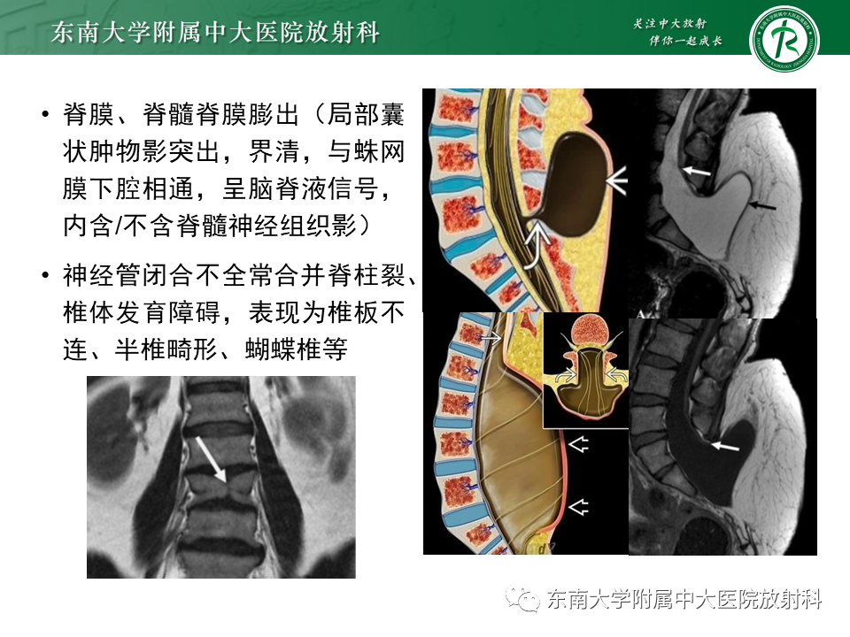 影像PPT - 【PPT】原发性脊髓拴系综合征-16 影像PPT - 【PPT】原发性脊髓拴系综合征-16
