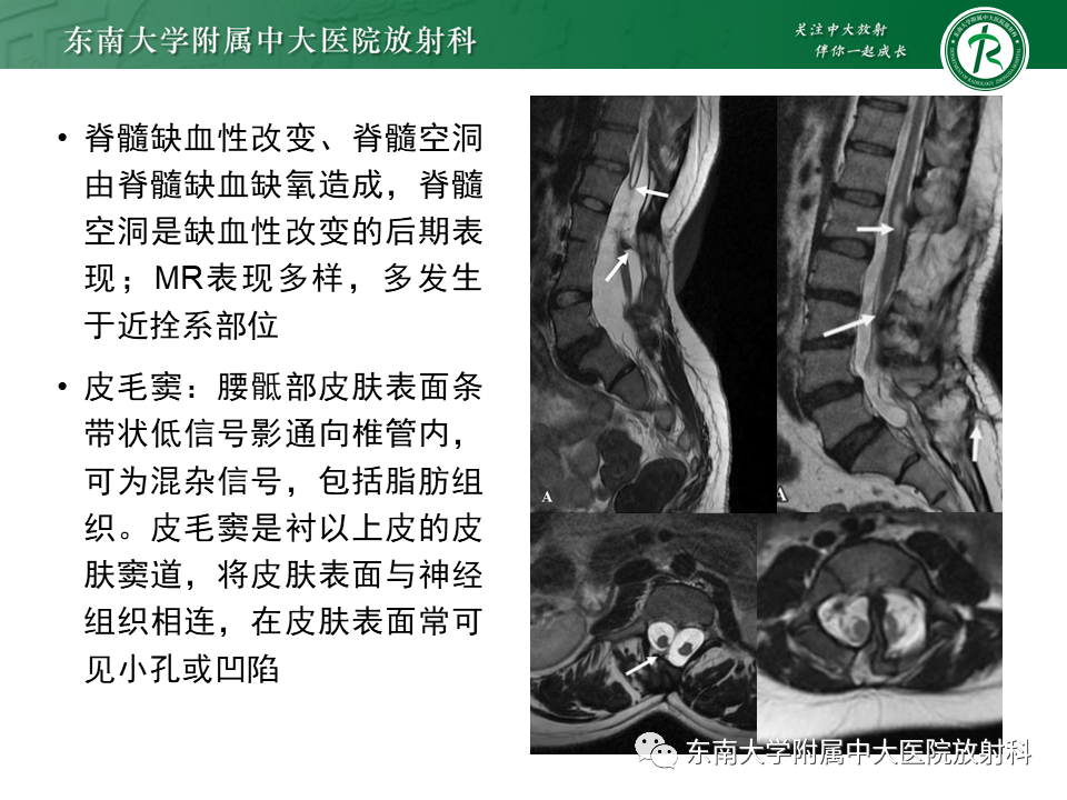 影像PPT - 【PPT】原发性脊髓拴系综合征-17 影像PPT - 【PPT】原发性脊髓拴系综合征-17