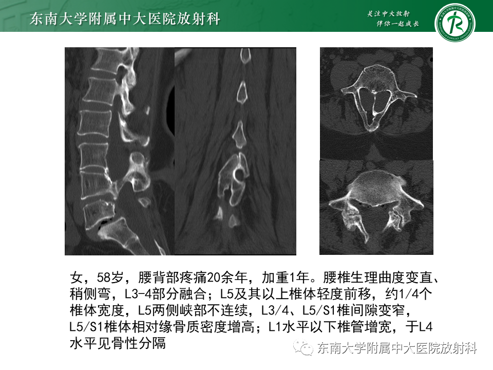 影像PPT - 【PPT】原发性脊髓拴系综合征-18 影像PPT - 【PPT】原发性脊髓拴系综合征-18