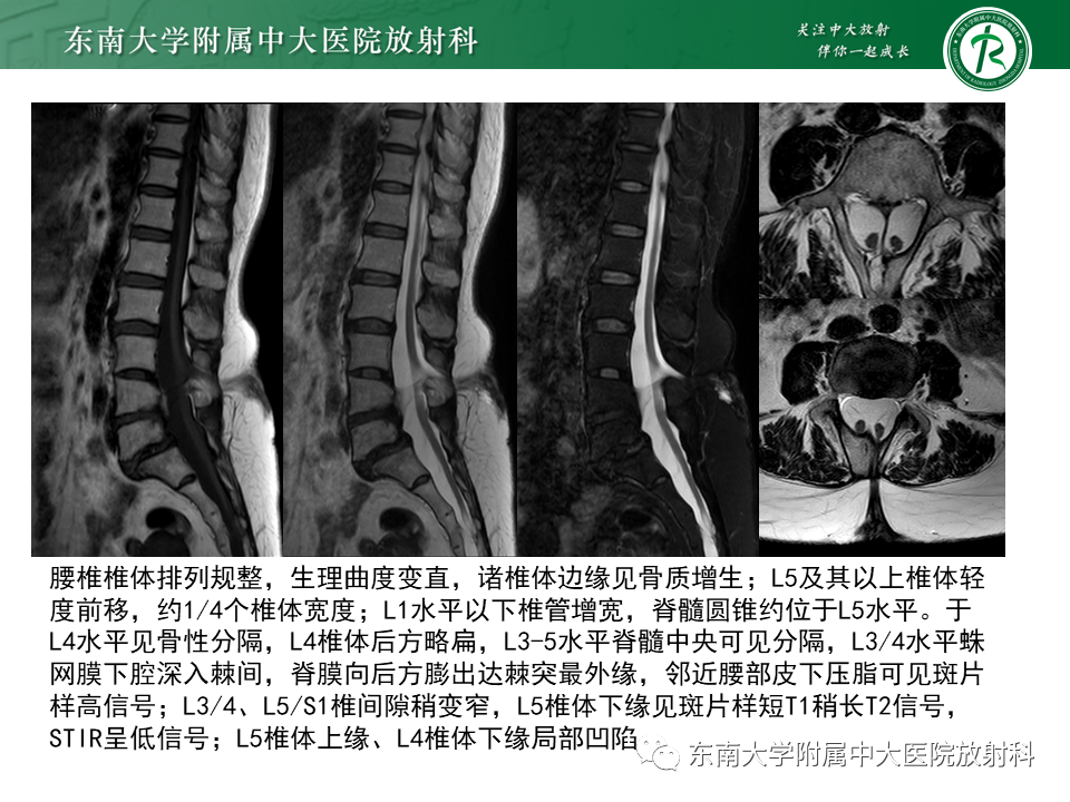 影像PPT - 【PPT】原发性脊髓拴系综合征-19 影像PPT - 【PPT】原发性脊髓拴系综合征-19