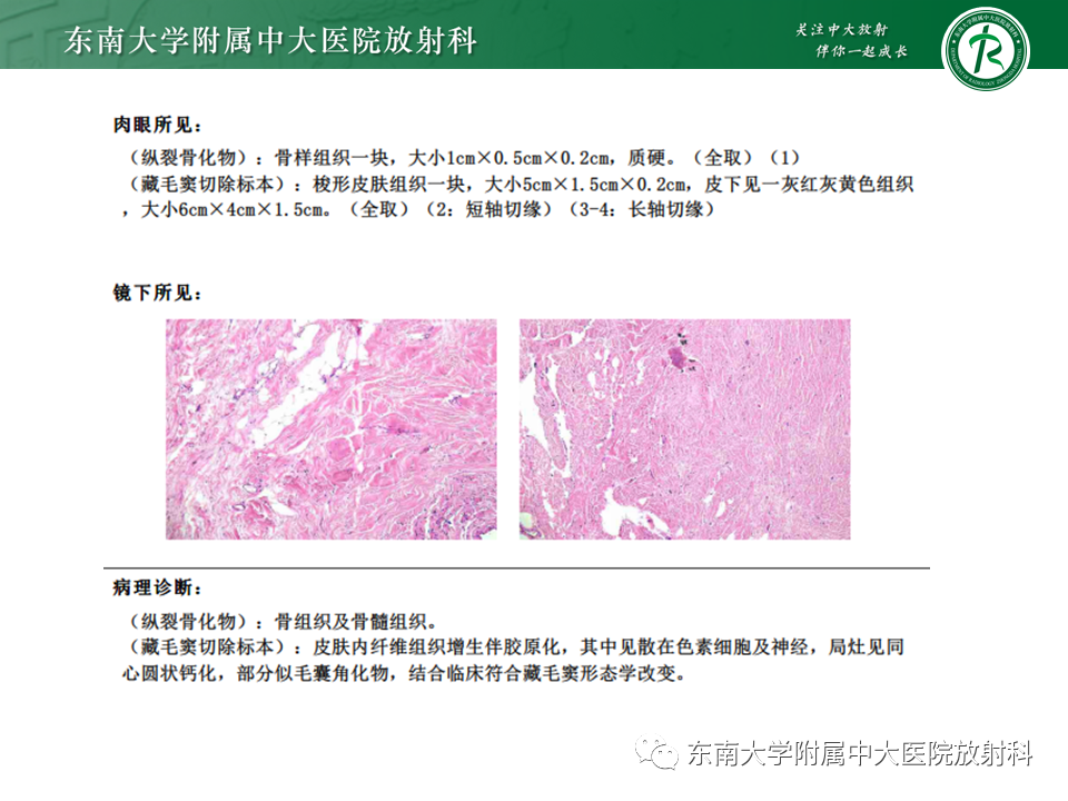 影像PPT - 【PPT】原发性脊髓拴系综合征-21 影像PPT - 【PPT】原发性脊髓拴系综合征-21