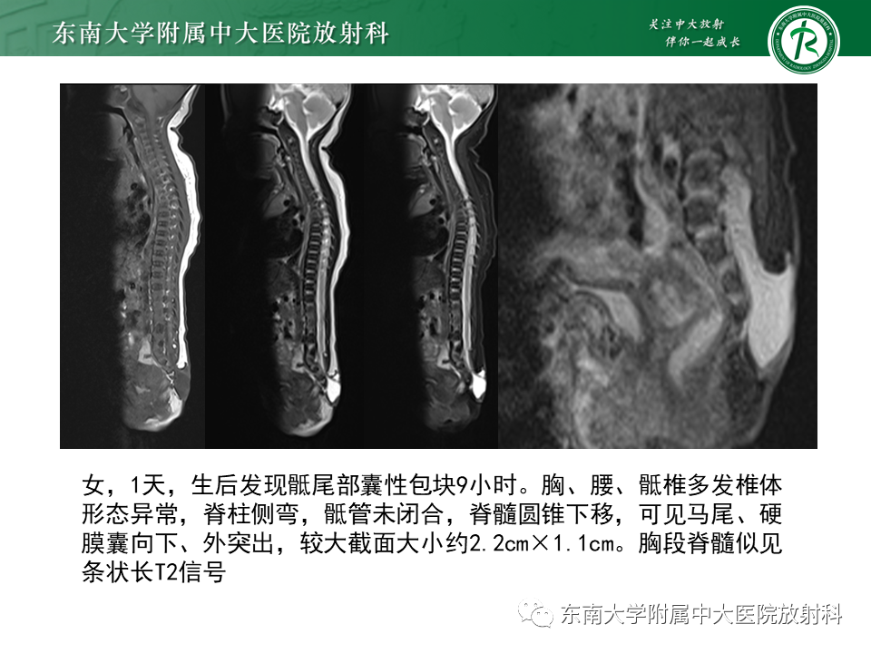 影像PPT - 【PPT】原发性脊髓拴系综合征-22 影像PPT - 【PPT】原发性脊髓拴系综合征-22