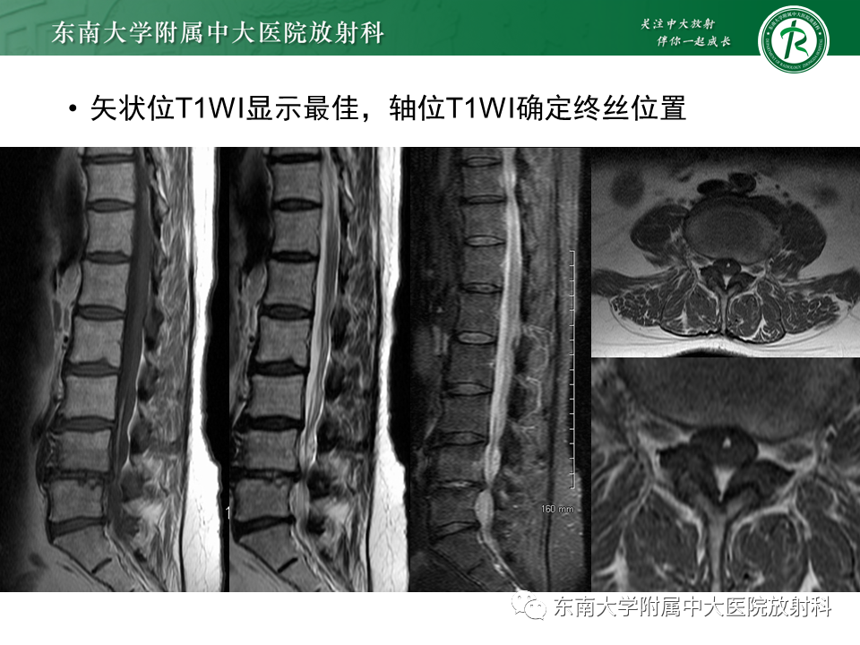 影像PPT - 【PPT】原发性脊髓拴系综合征-25 影像PPT - 【PPT】原发性脊髓拴系综合征-25