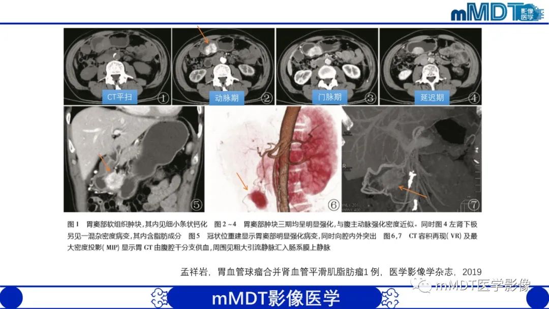 影像PPT - 【PPT】胃血管球瘤的影像诊断-6 影像PPT - 【PPT】胃血管球瘤的影像诊断-6