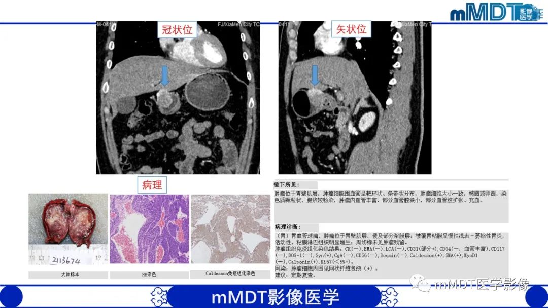 影像PPT - 【PPT】胃血管球瘤的影像诊断-3 影像PPT - 【PPT】胃血管球瘤的影像诊断-3