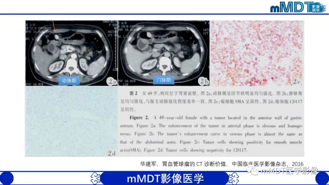 影像PPT - 【PPT】胃血管球瘤的影像诊断-7 影像PPT - 【PPT】胃血管球瘤的影像诊断-7
