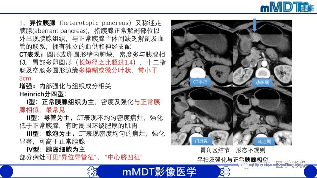 影像PPT - 【PPT】胃血管球瘤的影像诊断-12 影像PPT - 【PPT】胃血管球瘤的影像诊断-12