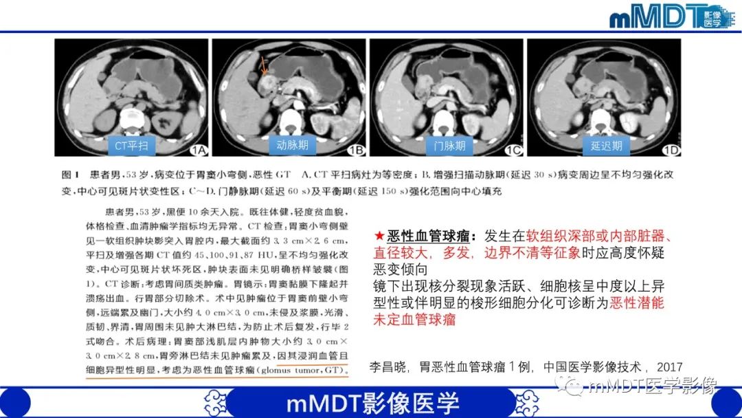 影像PPT - 【PPT】胃血管球瘤的影像诊断-10 影像PPT - 【PPT】胃血管球瘤的影像诊断-10