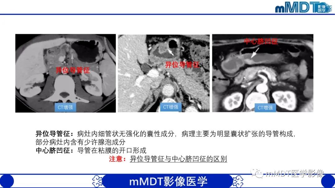 影像PPT - 【PPT】胃血管球瘤的影像诊断-13 影像PPT - 【PPT】胃血管球瘤的影像诊断-13