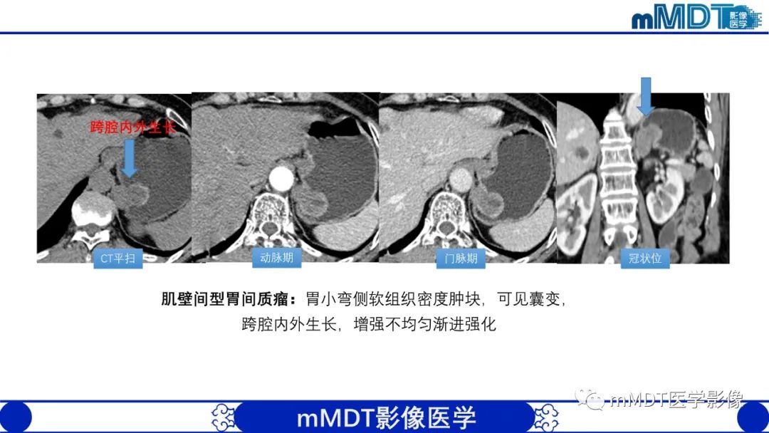 影像PPT - 【PPT】胃血管球瘤的影像诊断-14 影像PPT - 【PPT】胃血管球瘤的影像诊断-14