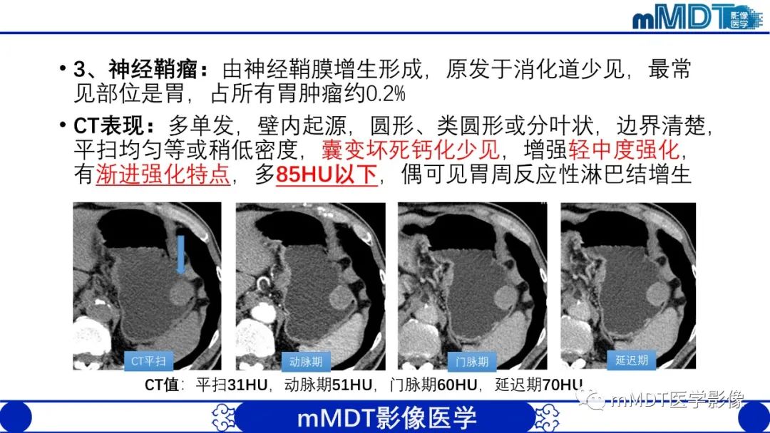 影像PPT - 【PPT】胃血管球瘤的影像诊断-15 影像PPT - 【PPT】胃血管球瘤的影像诊断-15