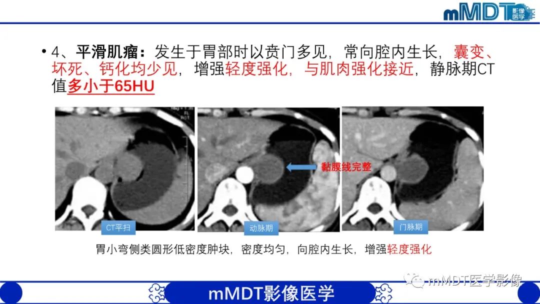 影像PPT - 【PPT】胃血管球瘤的影像诊断-16 影像PPT - 【PPT】胃血管球瘤的影像诊断-16