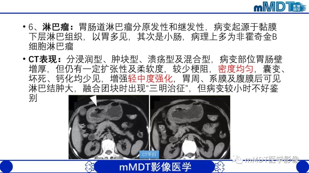 影像PPT - 【PPT】胃血管球瘤的影像诊断-18 影像PPT - 【PPT】胃血管球瘤的影像诊断-18