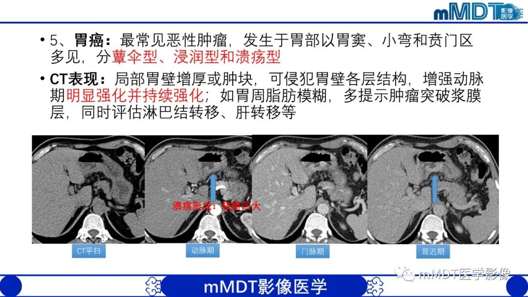 影像PPT - 【PPT】胃血管球瘤的影像诊断-17 影像PPT - 【PPT】胃血管球瘤的影像诊断-17